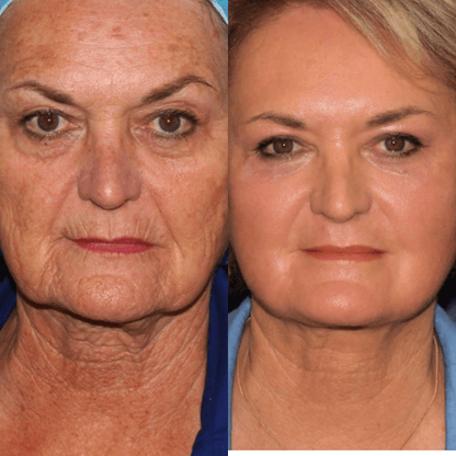Luxevéria | Erase 98% of Wrinkles & Look 15 Years Younger in Just 7 Days!
