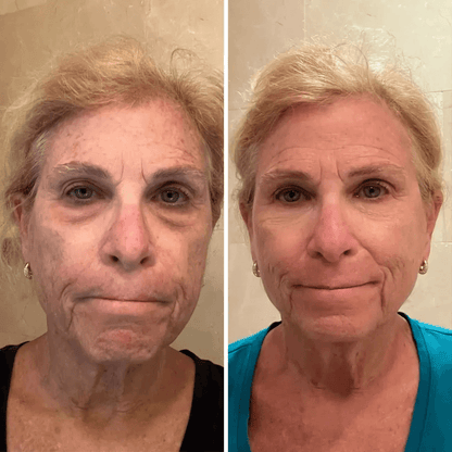 💥 Under-Eye Renewal Balm — Black Friday Special: 50% OFF!