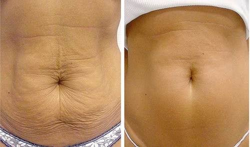 FerméLuxe | Firms sagging skin by 98% in 24 hours.